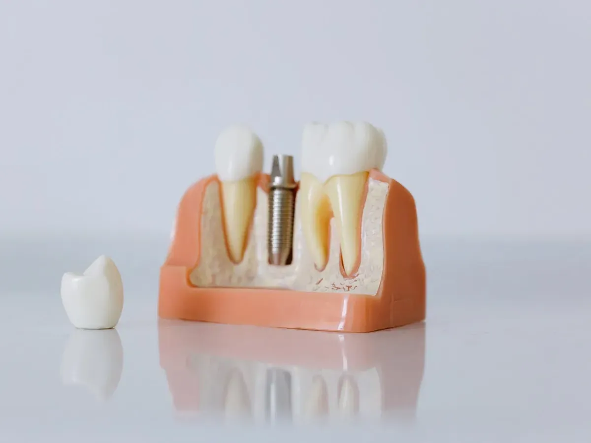 Dental Implants