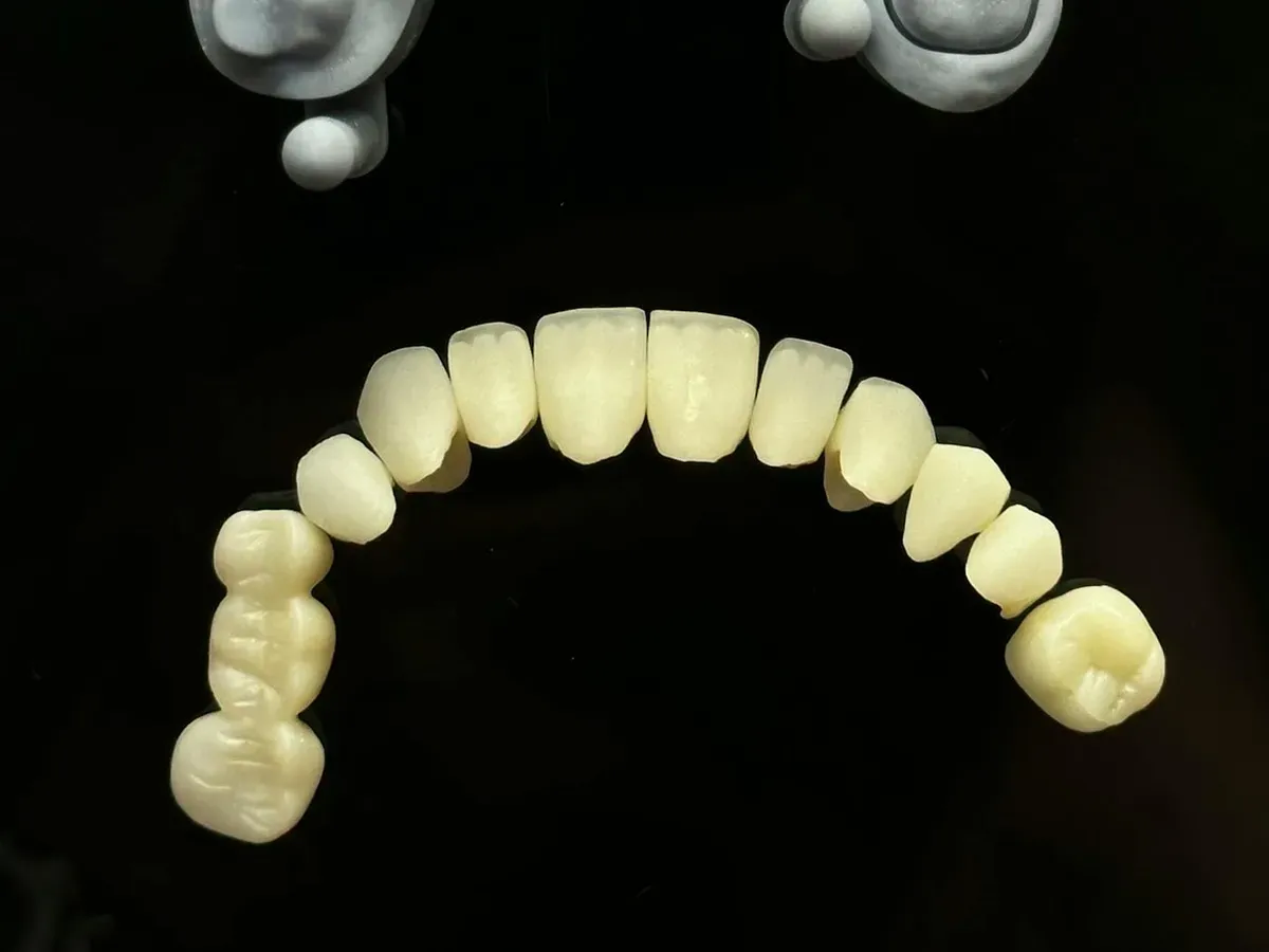 Crowns, Bridges & Fillings