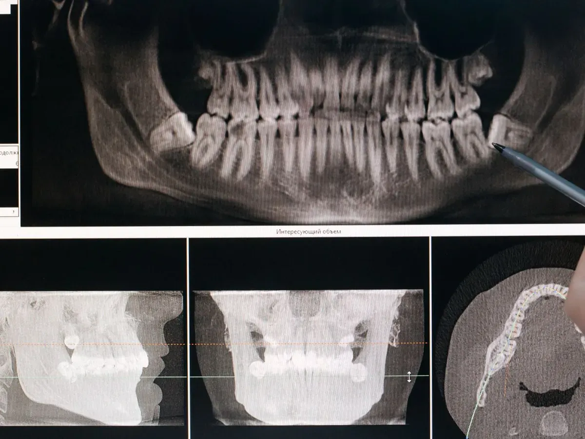 Root Canal Therapy